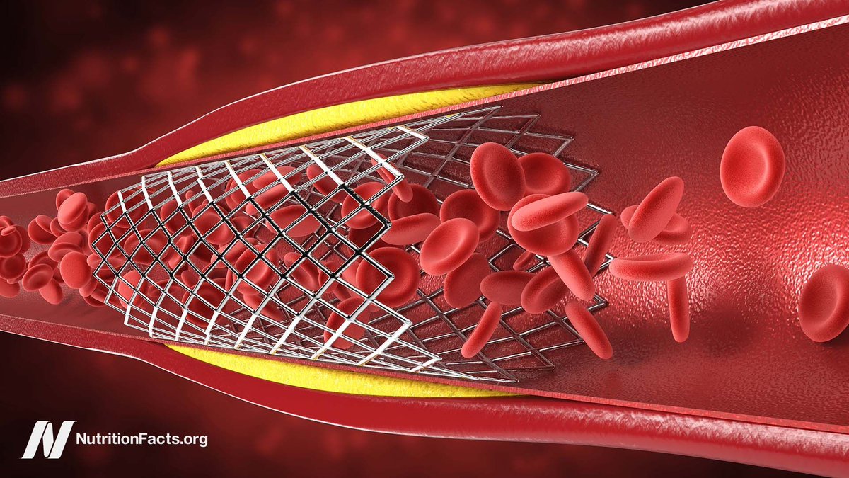 The Truth About Heart Stents. buff.ly/3UCDU9q