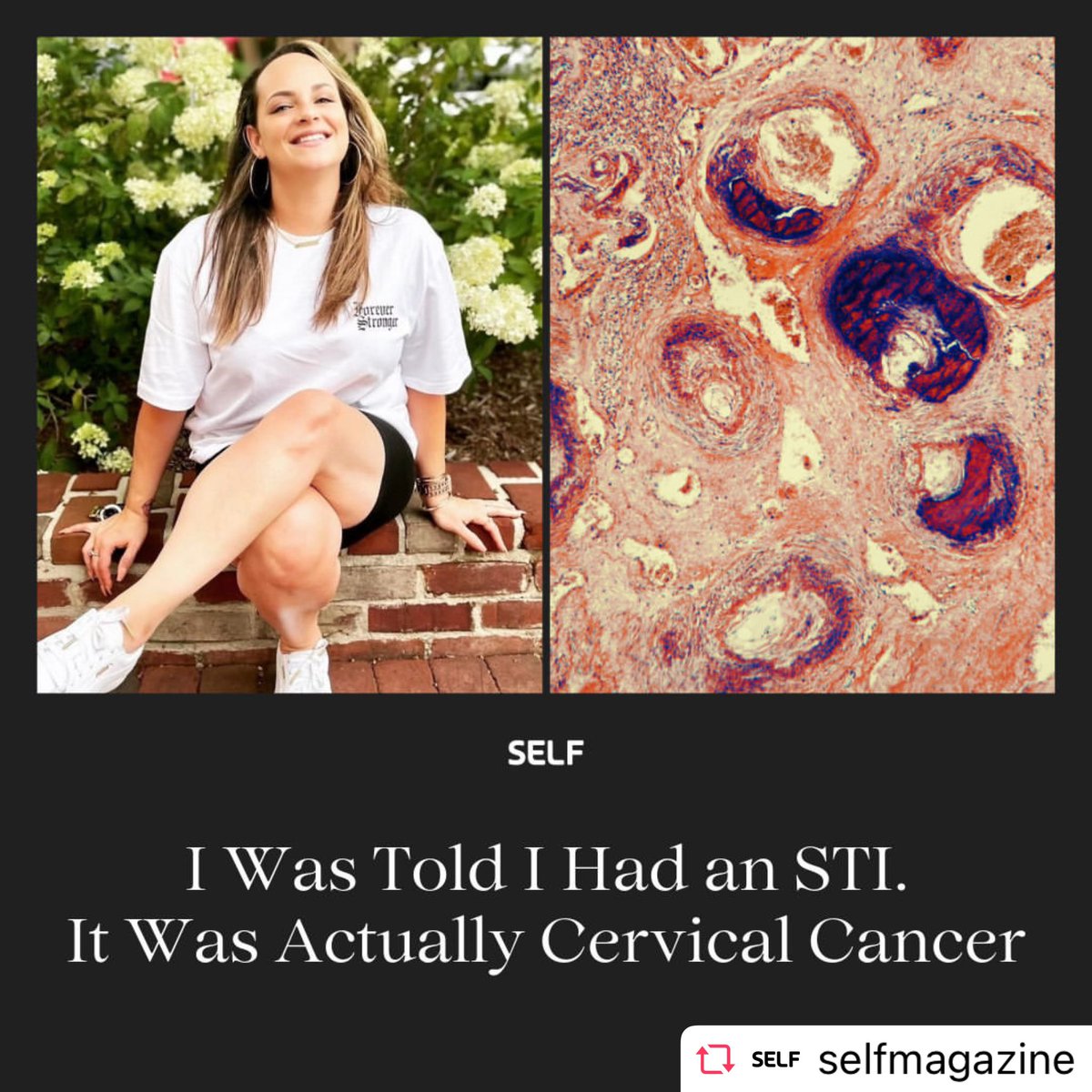 Shoutout to @AishaMcClellan_ feature in Self Mag! Our Cervical Cancer Program Coordinator shares her challenges navigating cervical cancer amidst motherhood, misdiagnosis, and self-advocacy. 📱 Follow her story here: bit.ly/3QLshKX #CervicalCancerAdvocate #gyncsm