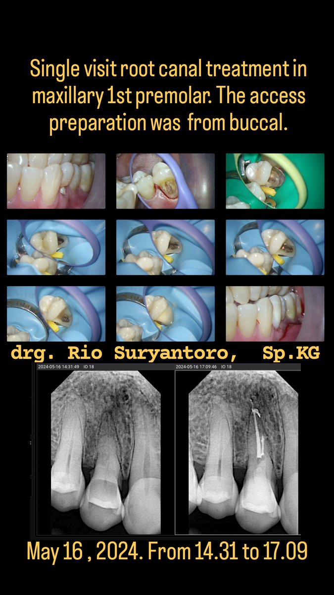 Single visit root canal treatment in maxillary 1st premolar. The access preparation was  from buccal.
May 16 , 2024. From 14.31 to 17.09.

Have a great endo day! ☕️