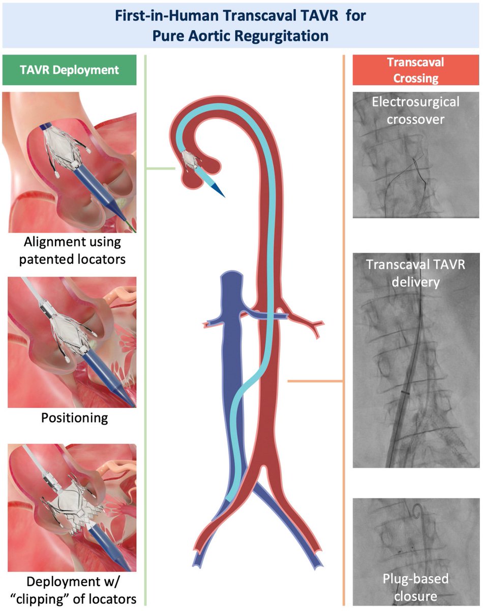 1️⃣st transcaval @JenaValve in pure AR @JACCJournals #JACCCR 🎯Brings Tx w/dedicated AR device (clippable self-expanding) to complex access cases Top team effort @UKKoeln @MattiAdam_MD @HWienemann @KEghbalzadeh @ElmarWKuhn @VictorMauriMD @NienaberStephan #treatAR #focusOnAR 🔗⤵️