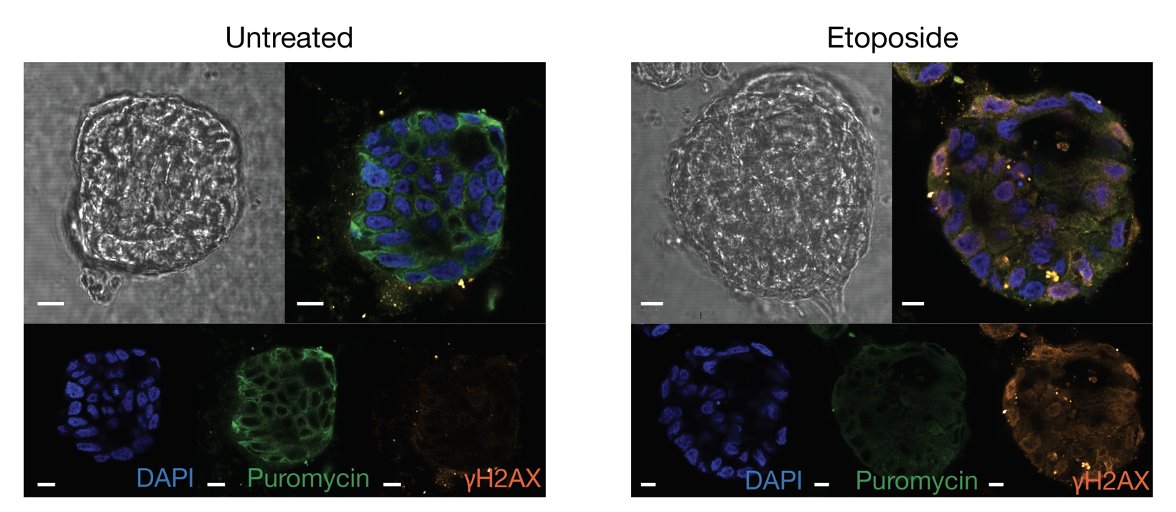 Thijn Brummelkamp (@thijnbrummel) on Twitter photo p53-independent apoptosis occurred through a ribotoxic stress response. The <a href="/Snippertlab/">Hugo Snippert</a> and <a href="/Schumacher_lab/">Ton Schumacher Lab</a> showed that ribosome stalling occurred in patient-derived organoids and healthy human T cells. This highlights ribosome stalling as a new signaling event upon DNA damage. p53-independent apoptosis occurred through a ribotoxic stress response. The <a href="/Snippertlab/">Hugo Snippert</a> and <a href="/Schumacher_lab/">Ton Schumacher Lab</a> showed that ribosome stalling occurred in patient-derived organoids and healthy human T cells. This highlights ribosome stalling as a new signaling event upon DNA damage.