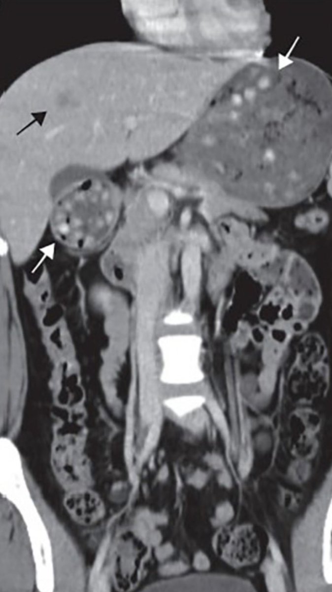 On my last #EM shift, my resident showed me this interesting #CTScan from Kao et al. If you ever wondered what #boba looks like in your stomach and duodenum, check out the white arrows PMID: 32995185