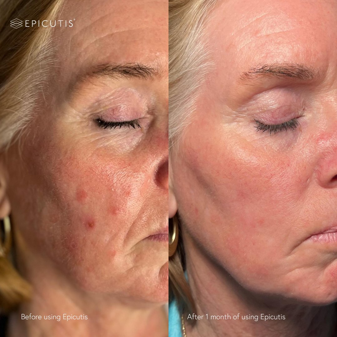 Check out the incredible results one month of Epicutis skincare can achieve! 😍 This individual used Epicutis' Simple System (oil cleanser, lipid serum + hyvia crème) consistently for one month and WOW is her skin healthy and glowing! 👏🤍