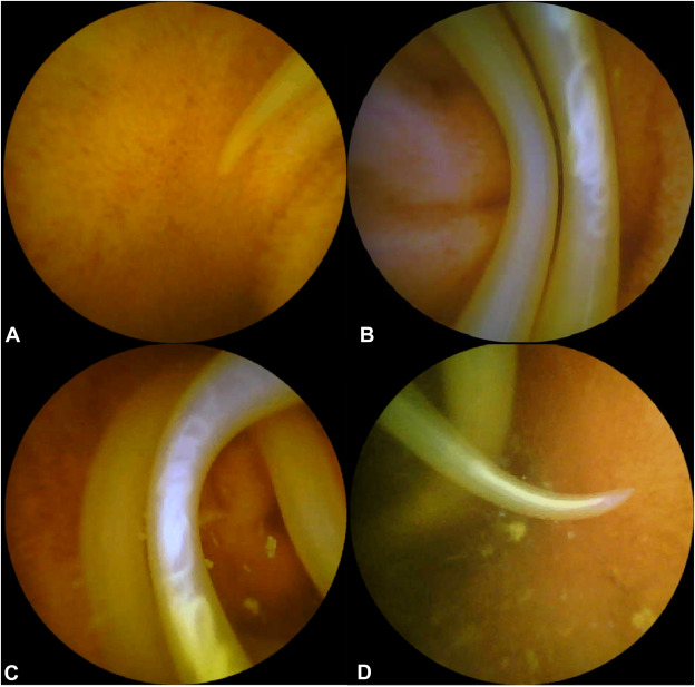 At the Focal Point, Zeng et al report on 'Successful diagnosis by capsule endoscopy of small intestinal ascariasis that had been misdiagnosed repeatedly.' giejournal.org/article/S0016-…