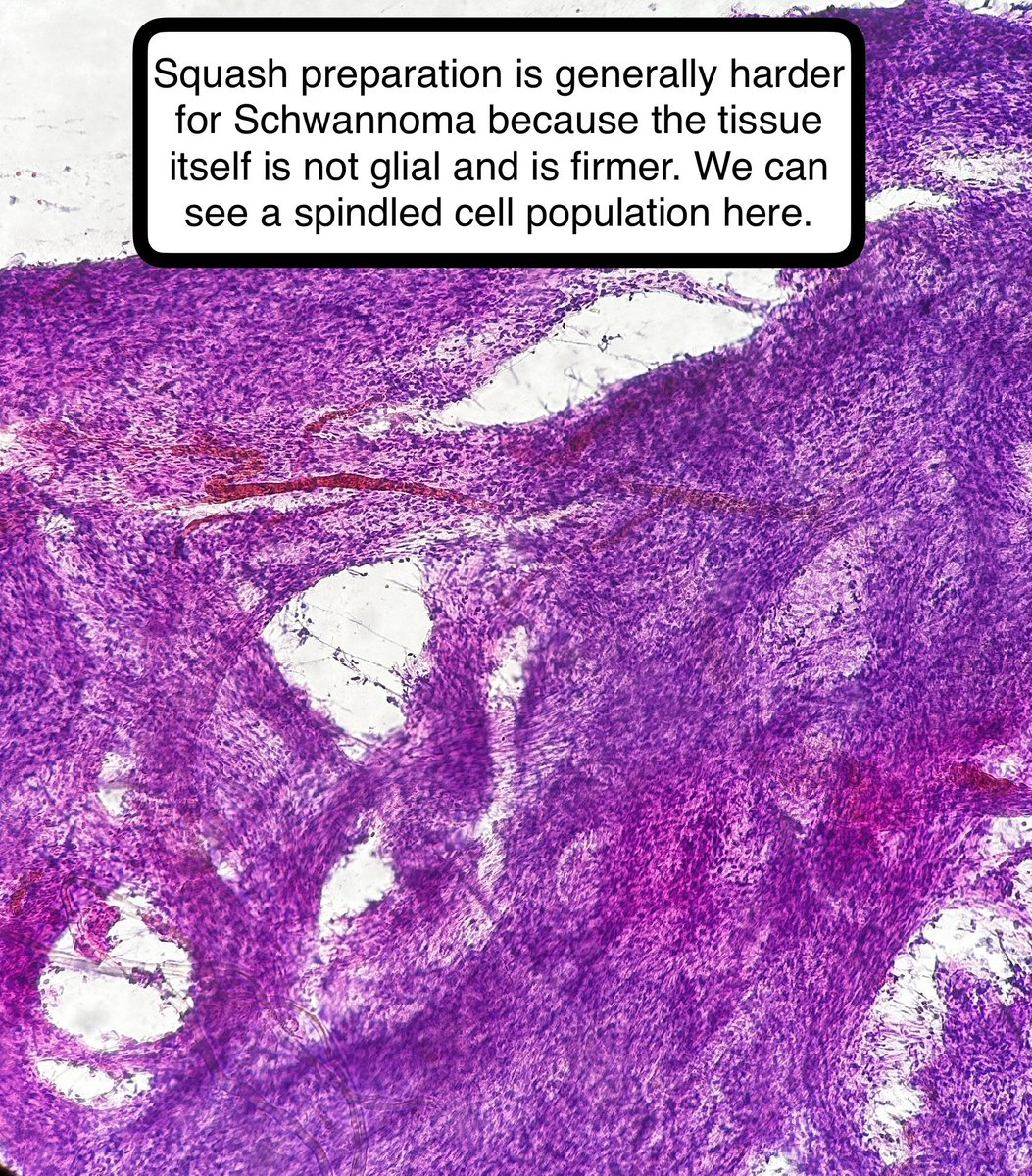 Schwannoma

• Benign tumor derived from Schwann cells (CNS WHO G1)

• There can be scattered atypical nuclei (ancient change)👇 

• Look for Antoni A (in which there are Verocay bodies) and Antoni B

• If bilateral vestibular schwannoma, think NF2 (Merlin)

#pathagonia #pathx