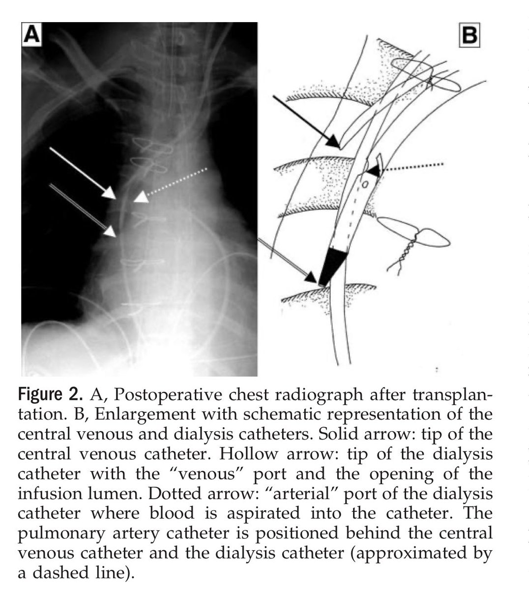 If your patients haemodynamics collapse shortly after commencing CRRT think about catheter placement

If the CVC tip is near the arterial access port of the dialysis catheter, substantial clearance of the upstream infused vasopressors can occur

1/