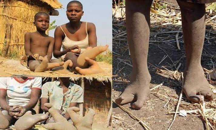 The vaDoma tribe is often referred to as the “two-toed” or “ostrich-footed” tribe. This nickname stems from a prevalent physical condition within the tribe known as Ectrodactyly. Ectrodactyly, also known as “lobster claw syndrome”, is a rare genetic condition characterized by