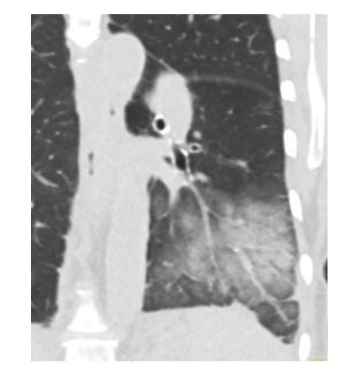 For #ThoracicThursday,  patient is feeling better after thoracentesis, so what is this finding on post procedure imaging?