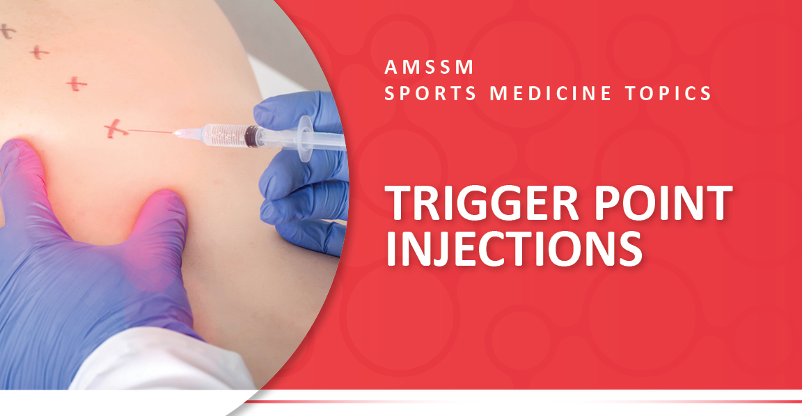 🚨 NEW TIP SHEET! 💉 Trigger point injections are a safe and quick procedure that can help relieve pain and discomfort from trigger points, which are localized painful areas within a muscle. ➡️ Learn more at SportsMedToday.com. sportsmedtoday.com/trigger-point-…