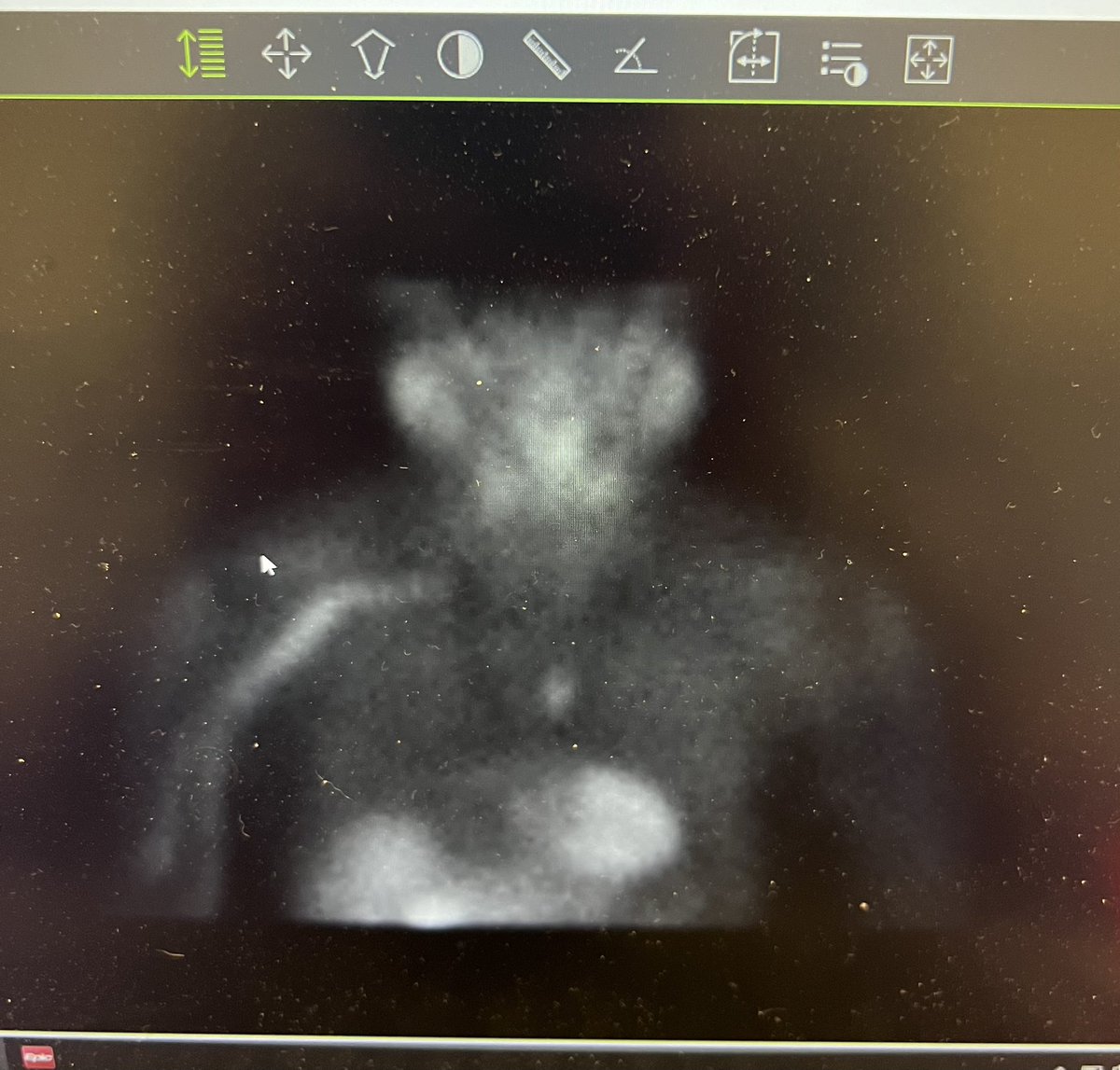 It's that time....  THORACIC THURSDAY!!

56yo M comes with kidney stones, some pain, with the scan below.

1) What abnormality would you see on labs?

2) how would you approach this?

3) is there anything you would do different intraoperatively?

#thoracicthursday #meded #surged