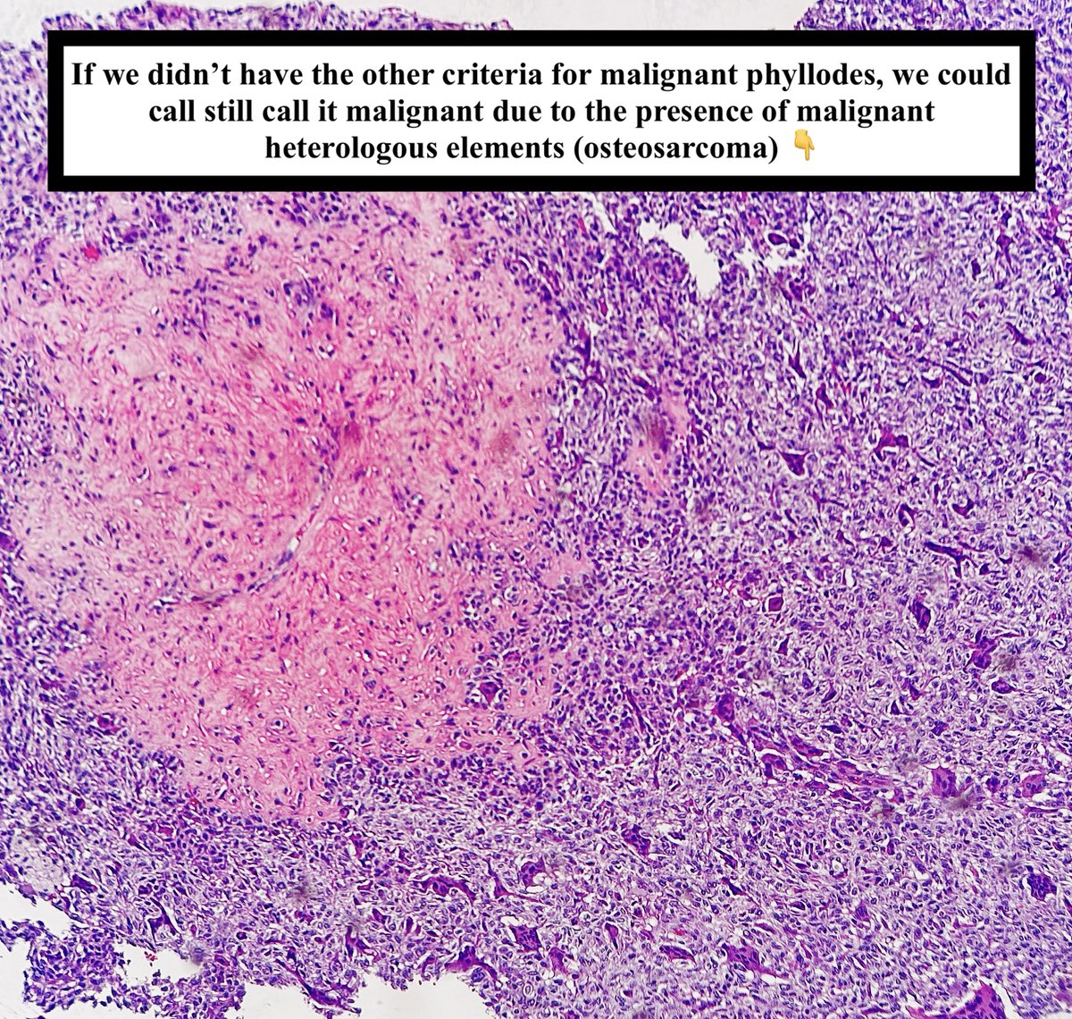 Malignant Phyllodes Tumor  

•More frequent among Hispanics in Central+South America  

•Malignant heterologous diff will get you to malignant phyllodes (exception: well-diff liposarcoma)  

• Ddx: primary or metastatic sarcoma +metaplastic carcinoma (would be cytokeratin+)