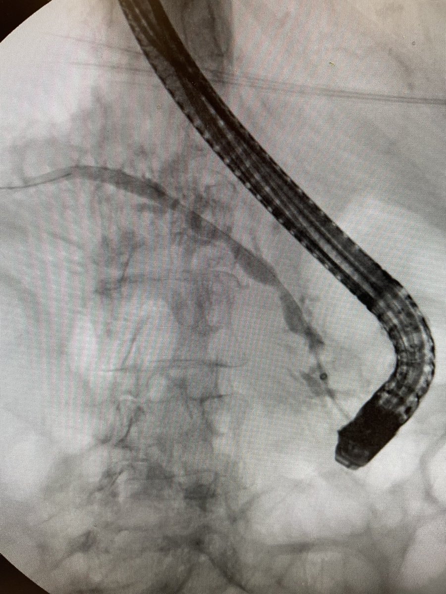 Thursday afternoon, chronic pancreatitis! #gitwitter #pancreas ⁦@NEndoscopy⁩