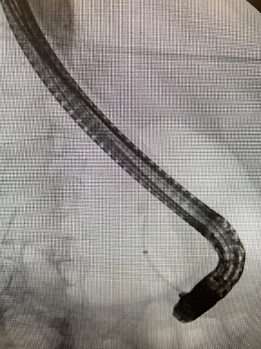 That is one phat pancreatic duct stone! Radio opaque! #pancreas #gitwitter ⁦@NEndoscopy⁩ ⁦@ASGEendoscopy⁩