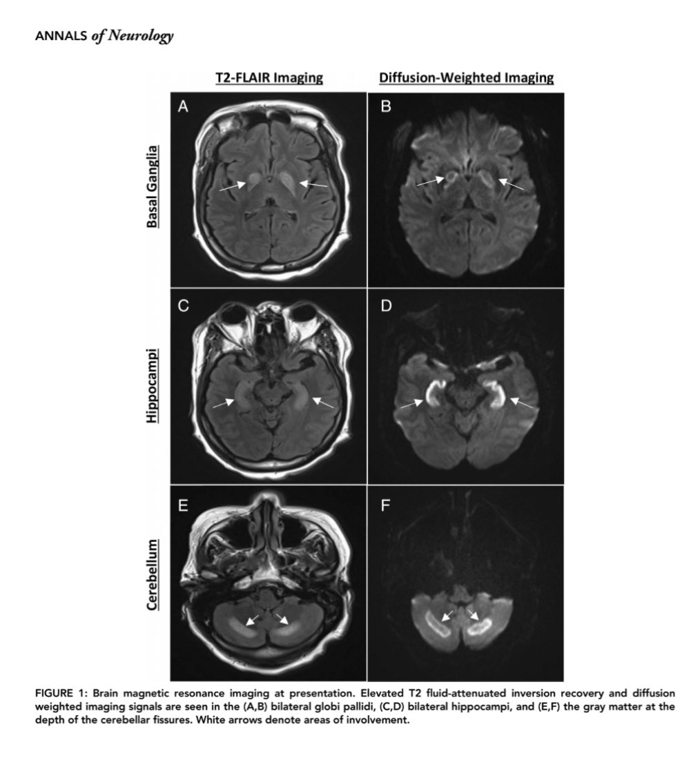 Execellent new case report on CHANTER syndrome in @TheNewANA1 Annals of Neurology by @francisdeng and @SidVenkatraman onlinelibrary.wiley.com/doi/10.1002/an… 1/2