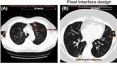 #AI assistive tool for #LungCancer screening improved specificity of radiologists in both US and Japan doi.org/10.1148/ryai.2… @GoogleHealth #cancer #screening #ML