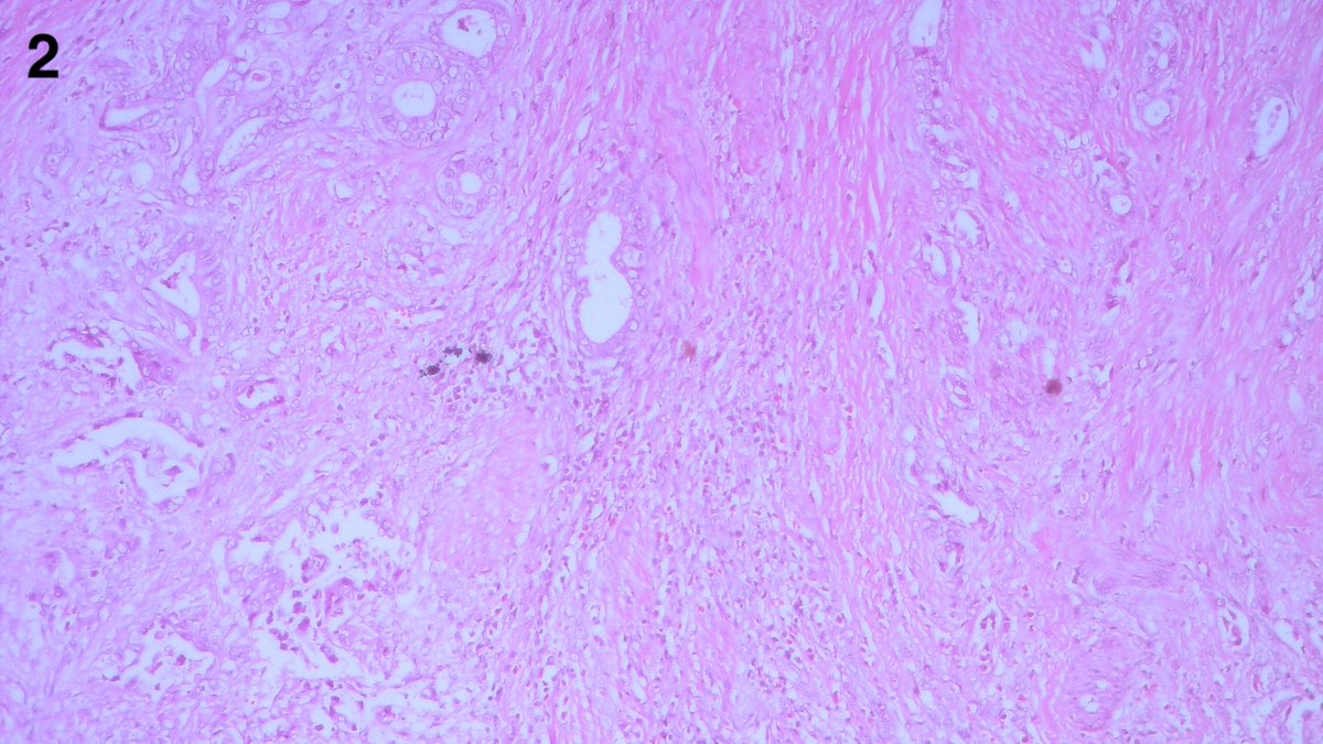 Surgical specimen of two stomach cancer cases are shown. Can you predict which one will be strong positive for HER2? #GIpath #Pathtweet #PathX