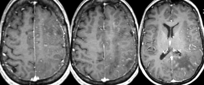 55 y/o F w/ hx of multiple sclerosis presents w/ confusion after recently discontinuing her MS therapy

🔷What is the most likely diagnosis and what was the drug?

More images in 🧵 

#meded #Neurology #medicine #neurosurgery #radres #FOAMed #futureradres #neurorad #ENT