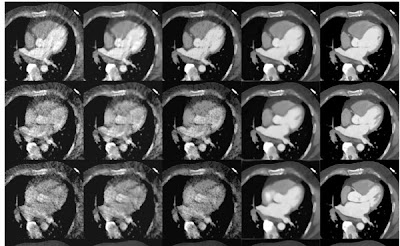Denoising Multiphase Functional Cardiac CT Angiography Using Deep Learning and Synthetic Data doi.org/10.1148/ryai.2… @StanfordRad @MarinaCodari @Mastrodicasa_MD #DeepLearning #SyntheticData #heart