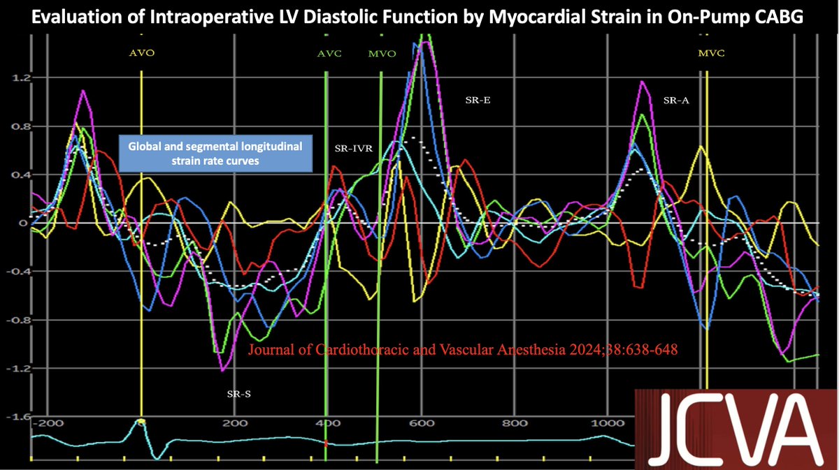 Evaluation of Intraoperative Left-Ventricular Diastolic Function by Myocardial Strain in On-Pump Coronary Artery Bypass Surgery #Diastolic strain analysis may be more sensitive in detecting diastolic function in intra-op TEE assessment. doi.org/10.1053/j.jvca… #echofirst
