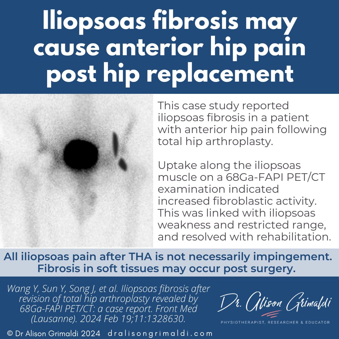 While iliopsoas impingement may occur after #THA, it is possible to have fibrosis without impingement and without the need for surgical release of the iliopsoas. Start with some good rehab to improve local soft tissue health. #anteriorhippain #iliopsoas #hiprehab