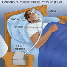 Sleep Apnea, confirmed!
Masa tu dia anjurkan 3 pilihan

1: Buat surgery, buang bahagian yang menghalang [tengok gambar pun ngeri].

2: Pakai mesin CPAP

Dan yang ini, memang kena usaha
3: Turunkan berat badan.

No 1 tu dia dah pesan siap², lepas operate tak semestinya sembuh.