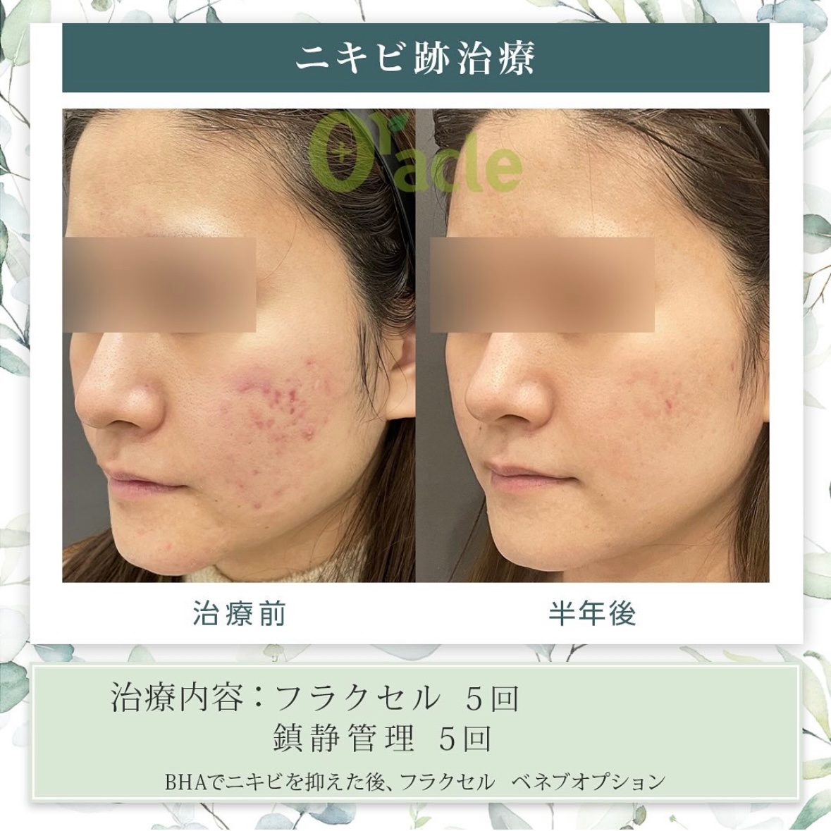 Oracle美容皮膚科と同じものです✴︎ Oracle美容皮膚科と同じものです✴︎ Oracle美容皮膚科と同じもの