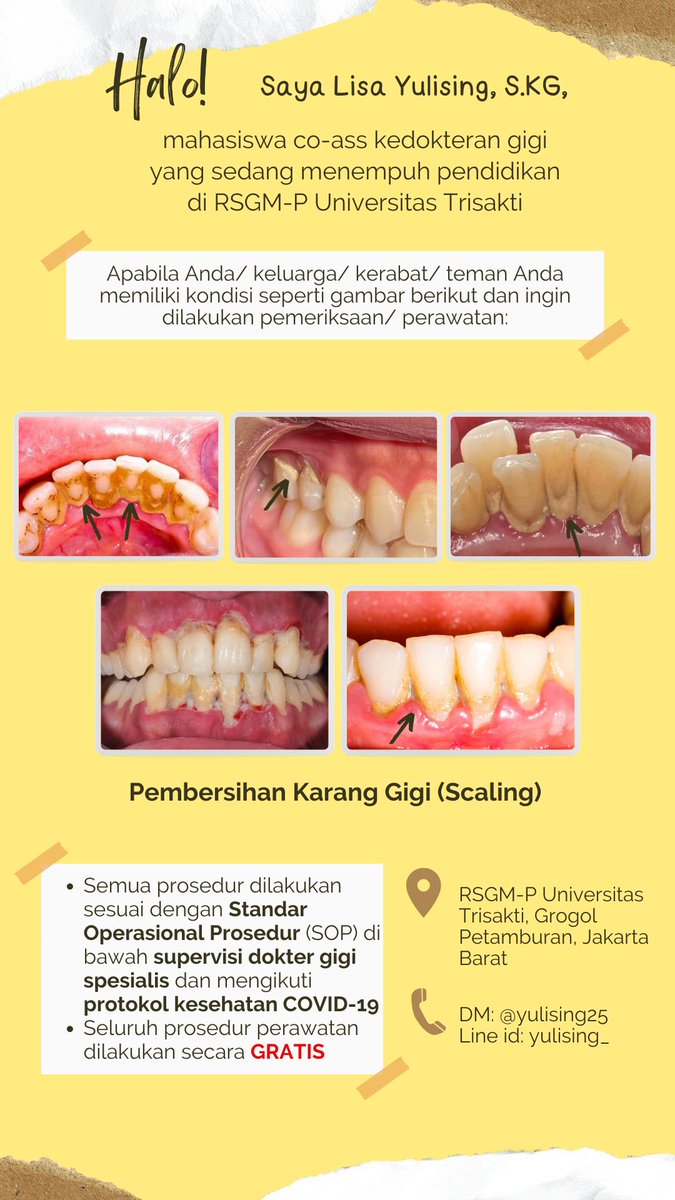 yulising25's tweet photo. Hallo, apabila ada yang memiliki keluhan karang gigi yang menumpuk dan mau dirawat boleh dm aja yaa untuk dibantu perawatannya terima kasih😊 #scaling #karanggigi #perawatangigi #sakitgigi #gusiberdarah #skeling #gigi #doktergigi #koasgigi #koas https://t.co/DZXeCr4l7O