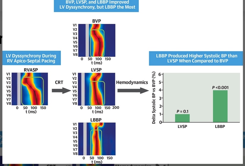 curilakarol (@curilakarol) on Twitter photo LVSP is as good CRT method as BVP, but LBBP is better. Importandly, all of them are perfect as they reduce dyssynchrony and lead to hemodynamic benefit in CRT patients.
jacc.org/doi/10.1016/j.…
<a href="/OCanoPerez/">Óscar Cano</a> <a href="/Marek_Jastrz_EP/">Marek Jastrzębski</a> <a href="/ZacharyWhinnett/">Zachary Whinnett</a> <a href="/kvernooy/">Kevin Vernooy</a> <a href="/MdHuang/">Weijian Huang</a> <a href="/DrRoderickTung/">Roderick Tung</a> LVSP is as good CRT method as BVP, but LBBP is better. Importandly, all of them are perfect as they reduce dyssynchrony and lead to hemodynamic benefit in CRT patients.
jacc.org/doi/10.1016/j.…
<a href="/OCanoPerez/">Óscar Cano</a> <a href="/Marek_Jastrz_EP/">Marek Jastrzębski</a> <a href="/ZacharyWhinnett/">Zachary Whinnett</a> <a href="/kvernooy/">Kevin Vernooy</a> <a href="/MdHuang/">Weijian Huang</a> <a href="/DrRoderickTung/">Roderick Tung</a>