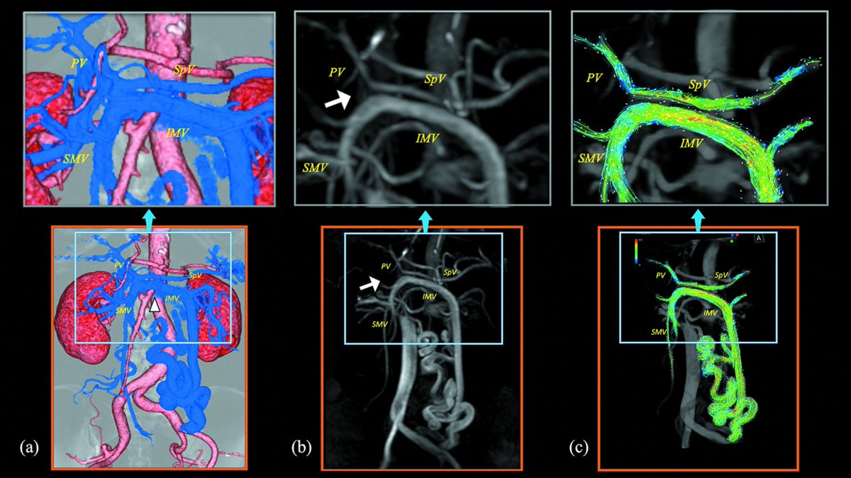 川崎医科大学の檜垣先生らによって肝性脳症を伴う門脈体循環シャントの患者が開腹下で腸間膜静脈結紮術を受け、門脈血流および血中アンモニアの改善が見られた論文が公開されました。4D Flow MRIが診断およびフォローアップに有用となったことが報告されています。  pubmed.ncbi.nlm.nih.gov/38417875/ #MRMS