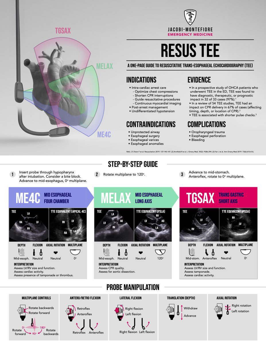 SAEM Academy of Emergency Ultrasound (AEUS) (@saemaeus) on Twitter photo The winning infographic for #SAEM #Sonogames24 Round 0 goes to <a href="/Jacobi_EM/">Jacobi/Montefiore EM</a> and their one page guide to #ResuscitativeTEE The winning infographic for #SAEM #Sonogames24 Round 0 goes to <a href="/Jacobi_EM/">Jacobi/Montefiore EM</a> and their one page guide to #ResuscitativeTEE
