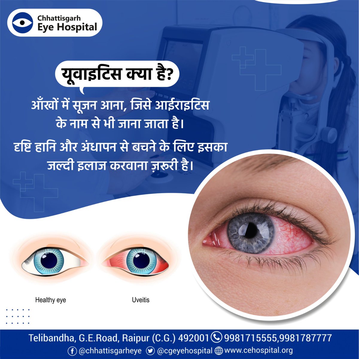 यूवाइटिस आँखों में सूजन की एक स्थिति है, जिसे आईराइटिस के नाम से भी जाना जाता है। यूवाइटिस के लक्षणों में आंखों में दर्द, धुंधली दृष्टि, प्रकाश के प्रति संवेदनशीलता और आँखों से पानी आना शामिल हो सकते हैं। 
#eyecare #eyehospital #eyedisease