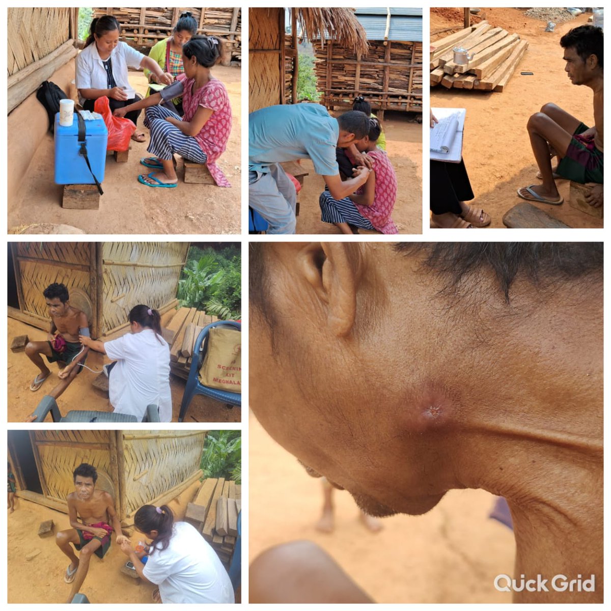 A team from Gitokgre HWC, recently undertook a home visit to care for Dineng M Sangma, a 54 yrs, from Jingamgre #EastGaroHills. Despite his severe health challenges, due to a painful abscess behind his left ear, the team ensured he received immediate attention.
#HealthForAll