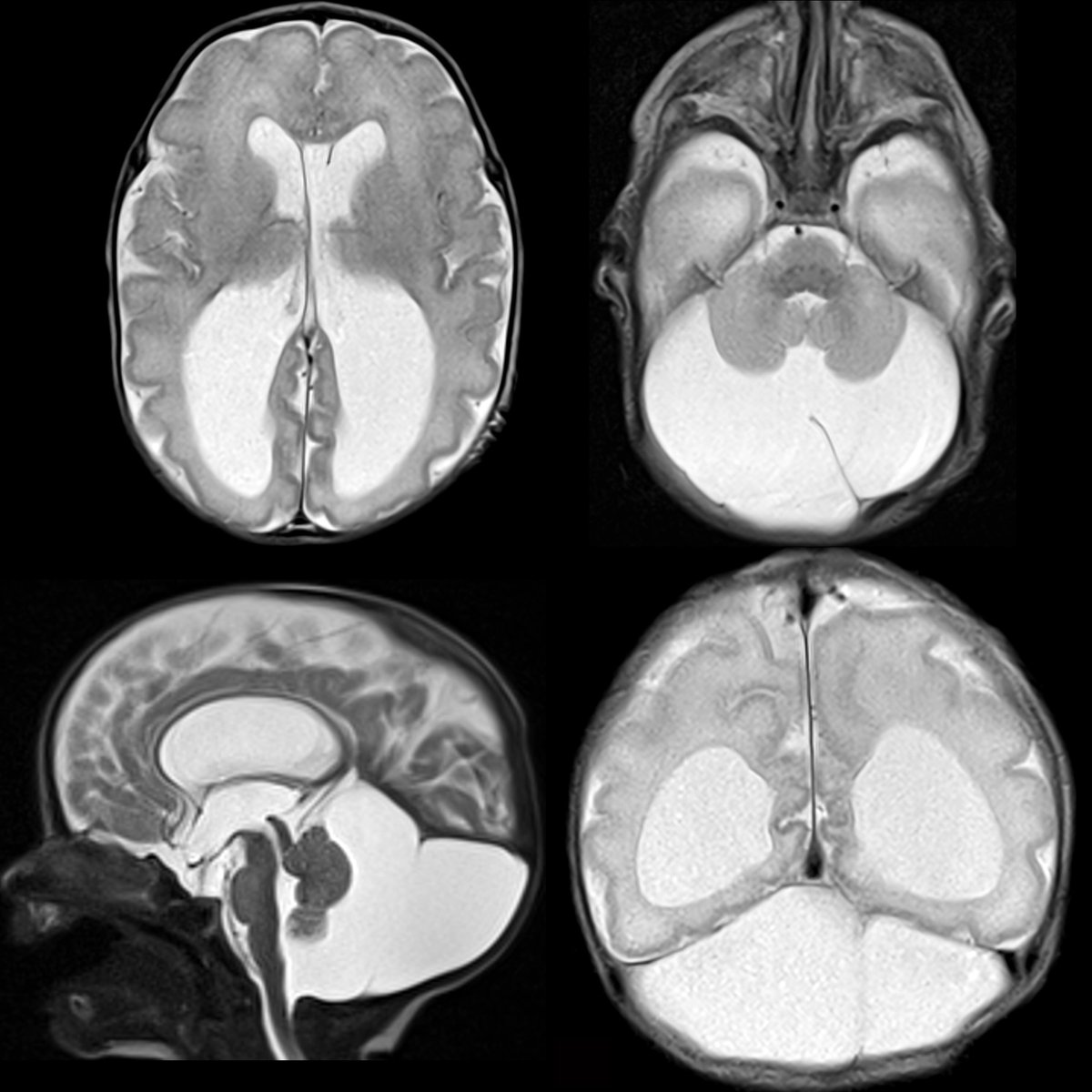 Newborn with hydrocephalus on prenatal US

Axial(above)+sagittal(below left)+coronal(below right) T2 MRI shows dilation of lateral+third ventricles. Cerebellum is small in size+there is a large+fluid-filled posterior fossa

#FOAMed #MedEd #FOAMPed #FOAMRad #PedsRad #RadEd #RadRes