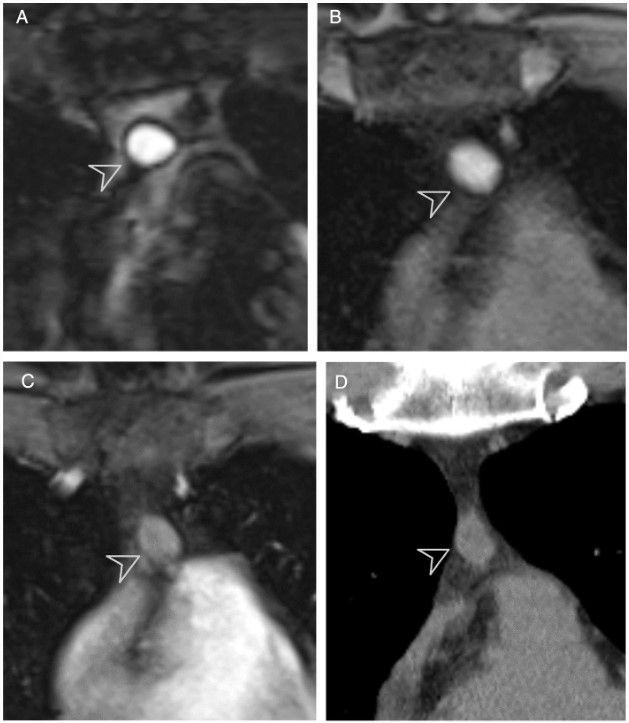 In this study, Jooae Choe et al. explore the reliability of using #MRI to diagnose anterior mediastinal cysts, finding MRI-based management may reduce the number of unnecessary follow-ups and surgeries.

#InsightsIntoImaging

🔗 buff.ly/3s6KARo