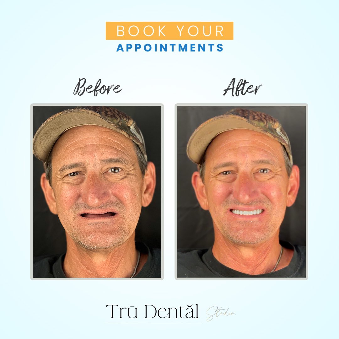 Remarkable changes start with a smile. Witness the power of our dental transformations in these stunning before and after shots.🦷✨#BeforeAndAfterTransformation #SmileJourney #DentalMagic #HappyClients #YouSmile #TransformYourSmile