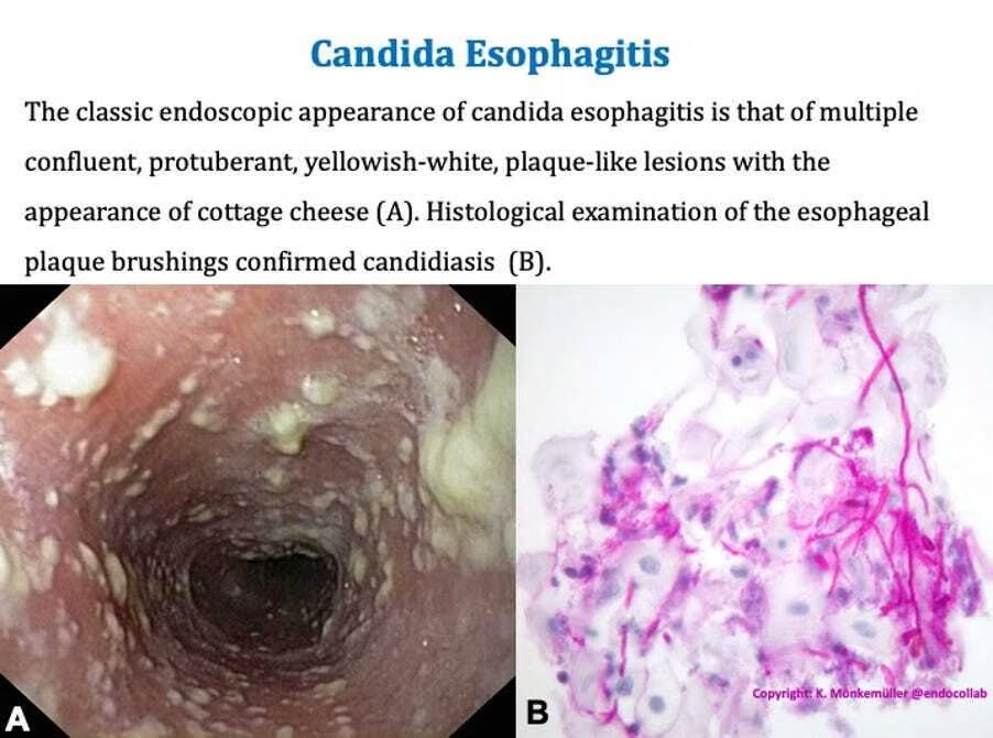 Case Study Patient: 68-year-old man with type 2 diabetes Symptoms: Dysphagia (difficulty swallowing) to solid foods, described as 'food sticking' in the upper chest area. Diagnosis: Endoscopy revealed yellowish-white, plaque-like lesions resembling cottage cheese, confirmed as