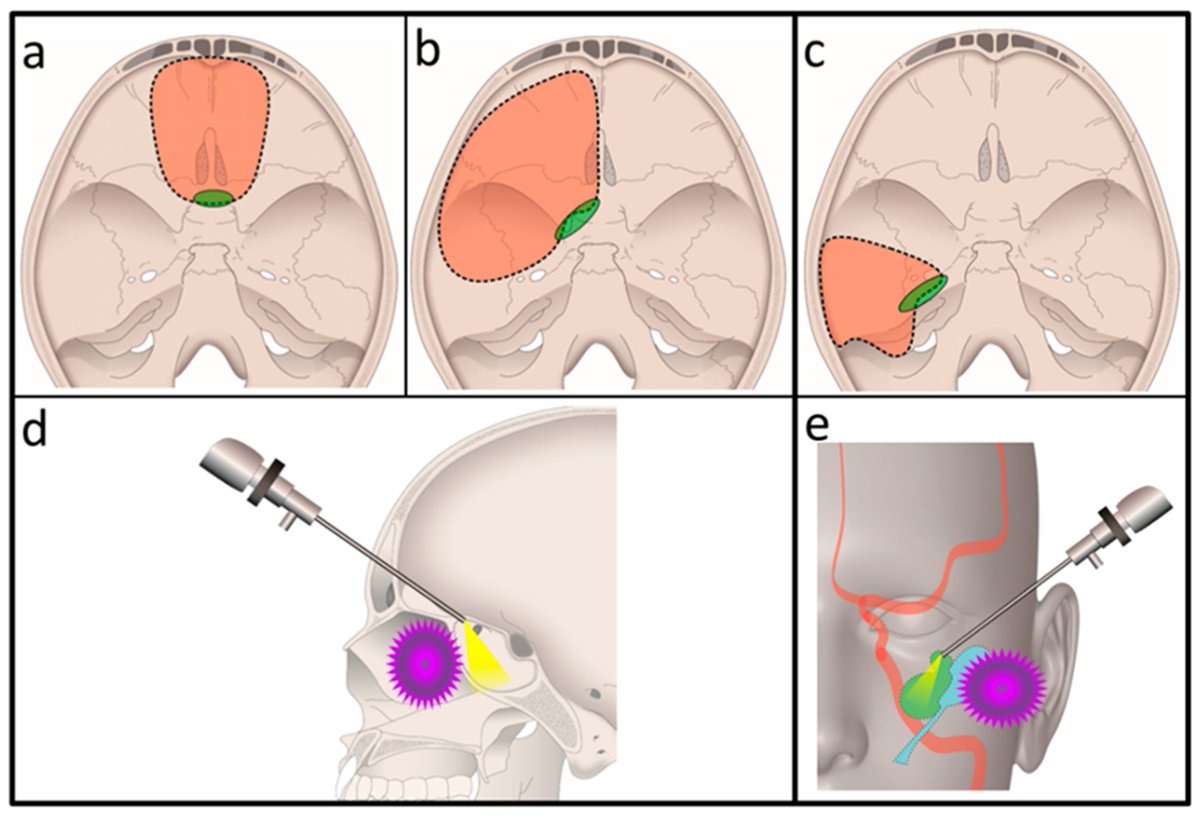 🔝 #HighlyCitedPaper Combined Exoscopic and Endoscopic Technique for Craniofacial Resection brnw.ch/21wJS3I #craniofacialresection #endoscope #exoscope