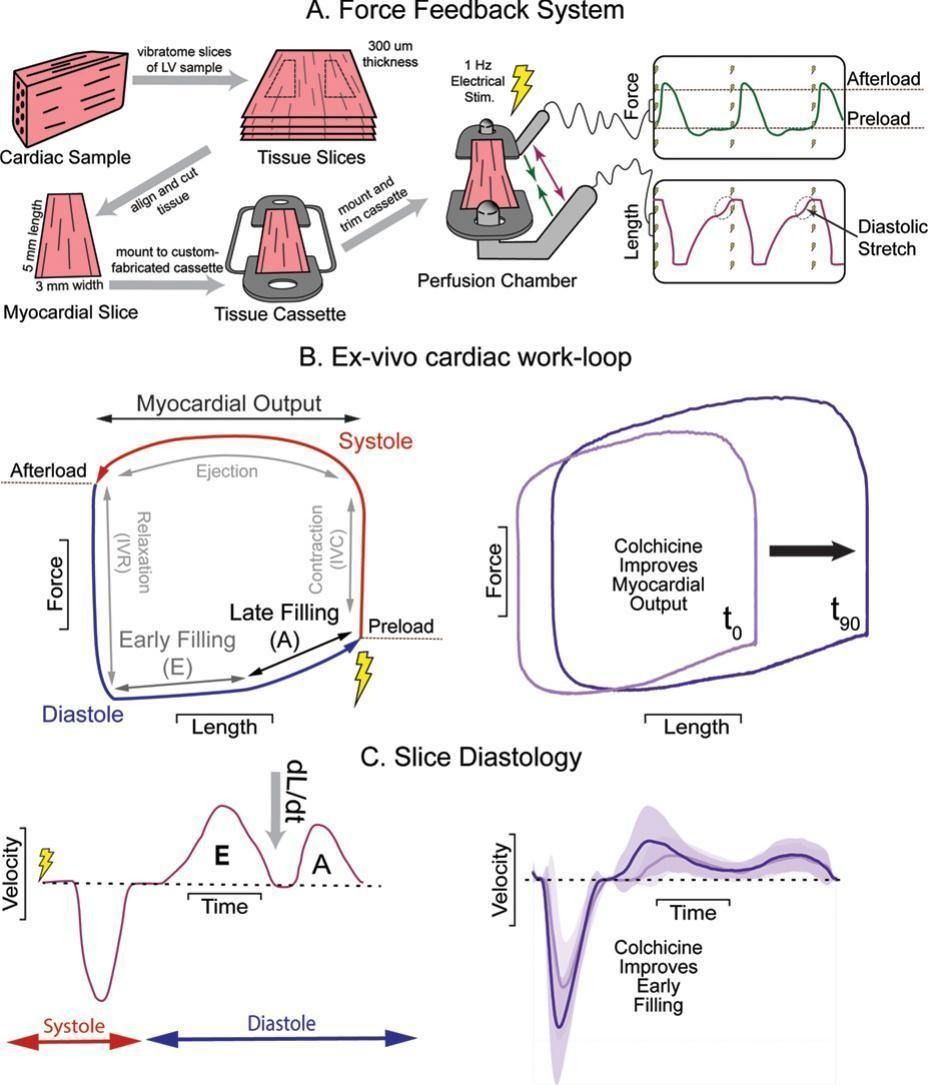 JMCC Plus (@jmccplus) on Twitter photo Recently, Hancock et al. published a new method to quantify #diastolic performance in #myocardial #slices. Using this method they demonstrate a #microtubule destabiliser can improve #isovolumic #contraction and relaxation.
<a href="/MCaporizzo/">Matt Caporizzo</a> <a href="/UVMLarnerMed/">UVM Larner Med</a>
buff.ly/4aeUPTT Recently, Hancock et al. published a new method to quantify #diastolic performance in #myocardial #slices. Using this method they demonstrate a #microtubule destabiliser can improve #isovolumic #contraction and relaxation.
<a href="/MCaporizzo/">Matt Caporizzo</a> <a href="/UVMLarnerMed/">UVM Larner Med</a>
buff.ly/4aeUPTT