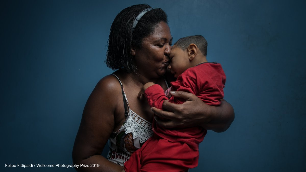 Pictured below is João from Brazil, who was born with microcephaly. He has a smaller head and an underdeveloped brain. This condition, which can cause long-term physical impairments, is becoming more common in Brazil because of Zika outbreaks. [1/3]