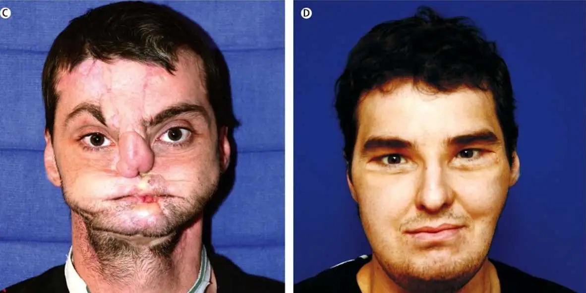 Richard Norris, disfigured from a self-inflicted gunshot, lived reclusively for 15 years. Surgeon Eduardo Rodriguez performed multiple unsuccessful surgeries, then opted for a full face transplant in 2012. He became the first person to successfully receive a new face transplant.