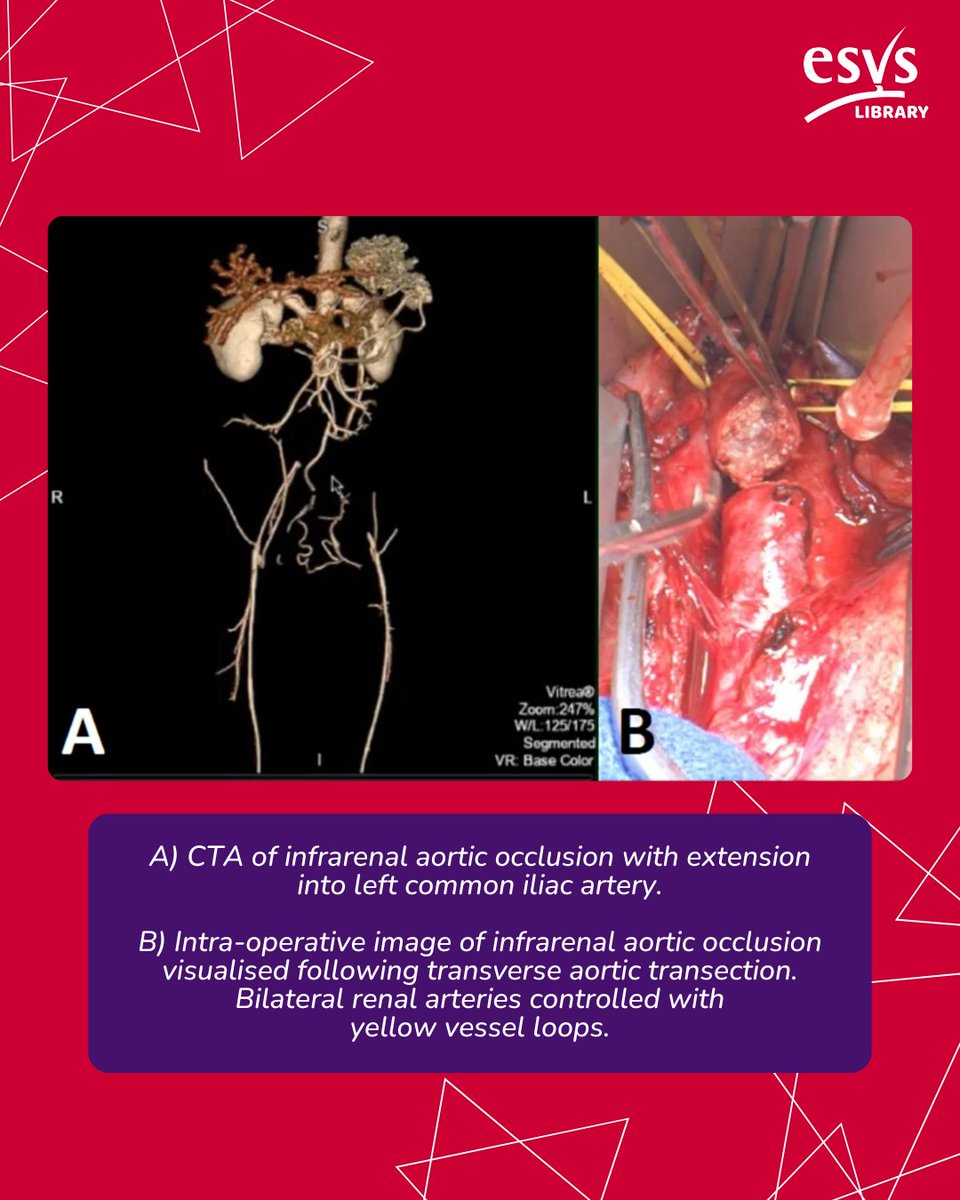 ESVS (@esvsmembership) on Twitter photo "Aortoiliac occlusive disease is a common pattern of peripheral artery disease that every vascular surgeon should be prepared to manage."
Read this new Virtual Vascular chapter on the Management of AIOD from <a href="/IanCookVS/">Ian Cook</a> , <a href="/RamyarGilaniMD/">RamyarGilani</a>, and <a href="/jmills1955/">Joseph L. Mills MD</a>
esvs.org/e-library-home/ "Aortoiliac occlusive disease is a common pattern of peripheral artery disease that every vascular surgeon should be prepared to manage."
Read this new Virtual Vascular chapter on the Management of AIOD from <a href="/IanCookVS/">Ian Cook</a> , <a href="/RamyarGilaniMD/">RamyarGilani</a>, and <a href="/jmills1955/">Joseph L. Mills MD</a>
esvs.org/e-library-home/