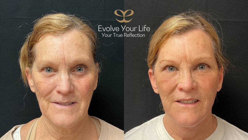 EvolveYourLife_'s tweet photo. As we age, we lose volume and develop sagging, excess skin in our face and neck. To address her aging related changed, we performed:
-Deep Plane Face Lift
-Platsymaplasty
-Fat Transfer
-Upper &amp; Lower Blepharoplasty
.
.
.
#evolveyourlife #facelift #browlift #necklift #bleph https://t.co/y29FwgTfdz