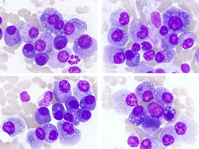 Granular Mott cells in multiple myeloma |American Journal of Hematology | Blood Research Journal | Wiley Online Library onlinelibrary.wiley.com/doi/10.1002/aj…