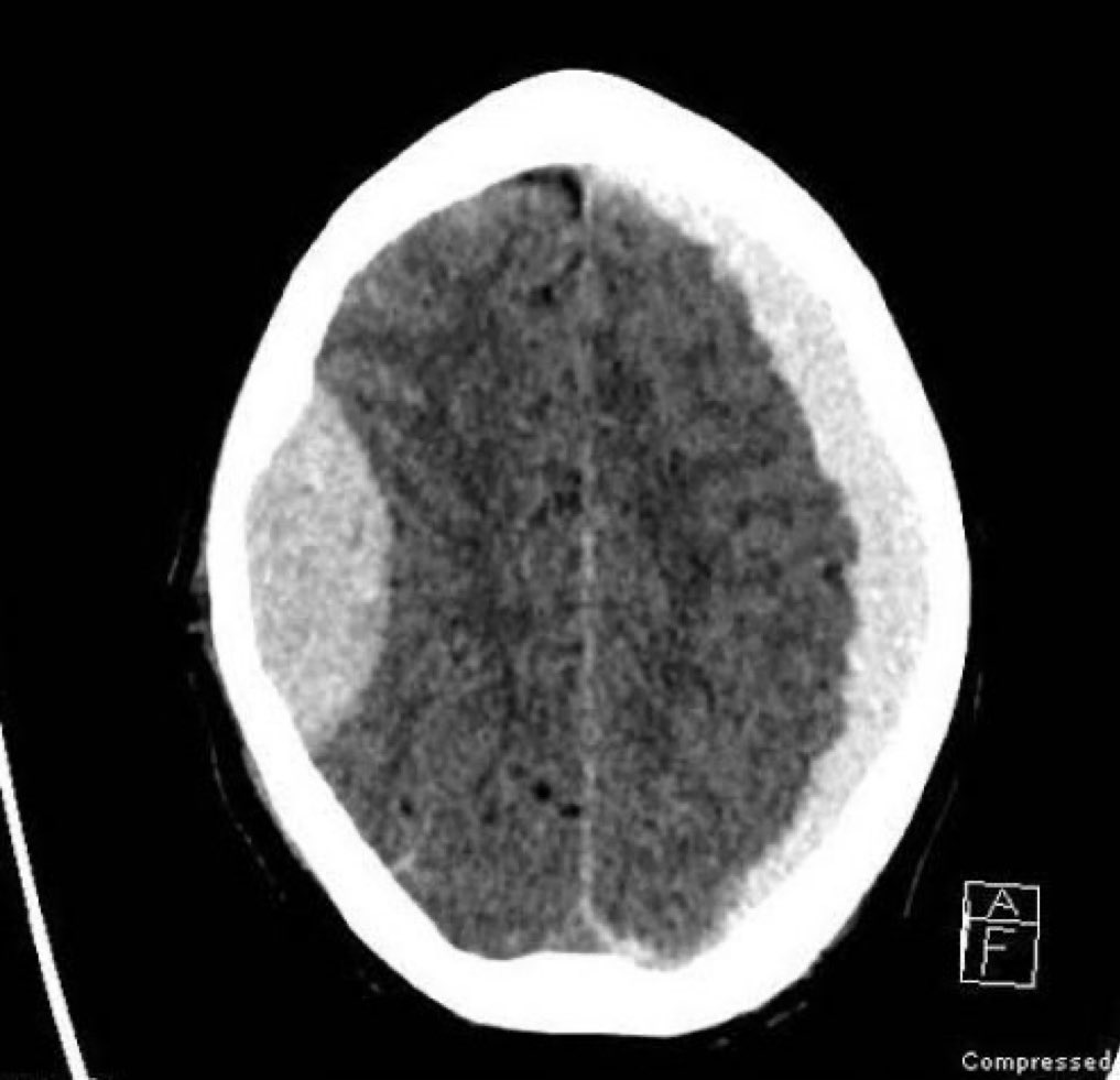 After a motorbike accident, the patient is brought drowsy to the hospital. What's your diagnosis!! #MedX #MedEd #MedTwitter H/T @Neuromed_