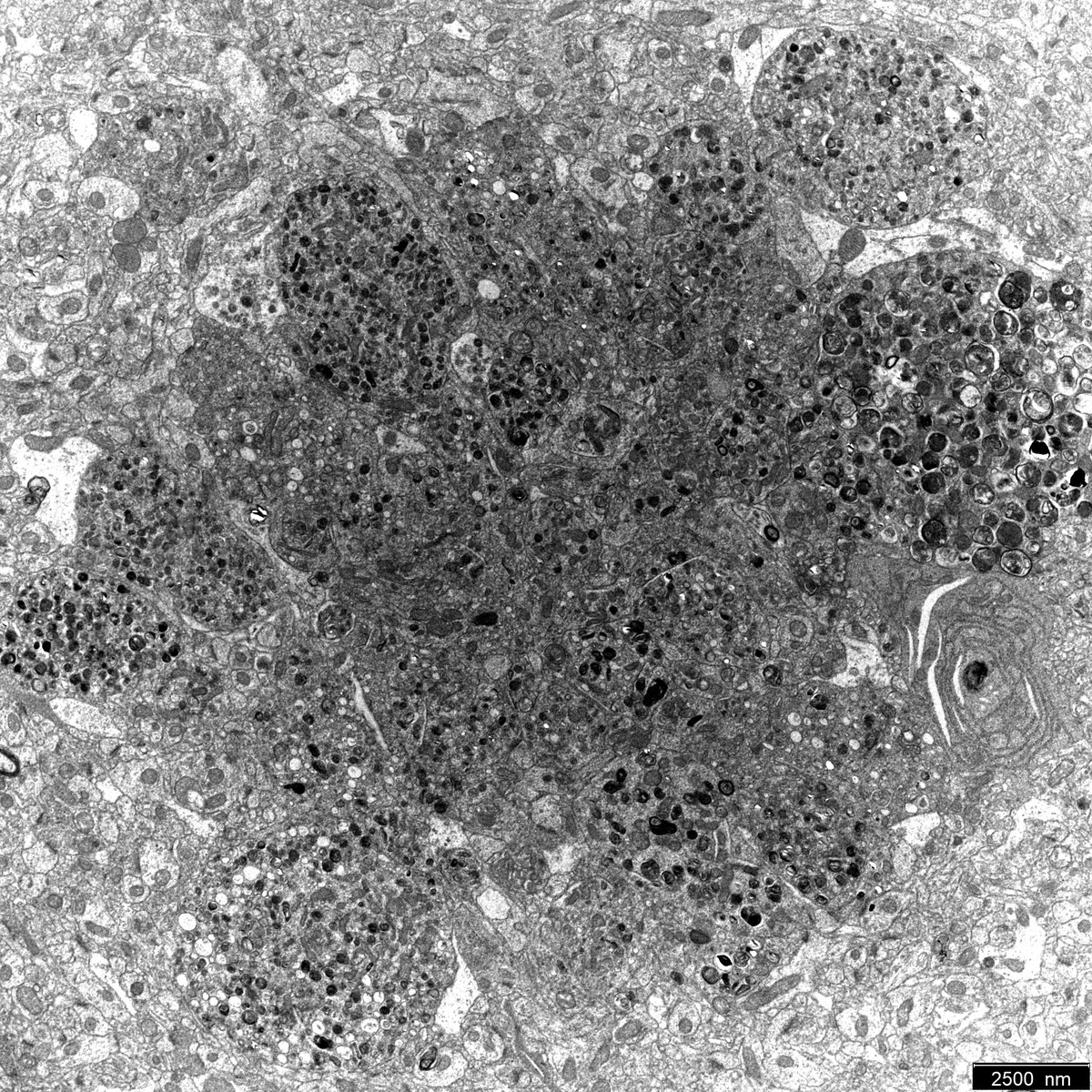 AOSasmita's tweet image. Electron micrograph of axonal swellings surrounding an Aβ plaque in the cortex of a 5xFAD mouse 🧠 Note the abundance of electron-dense autophagic vesicles in these swellings.
#ElectronMicroscopy