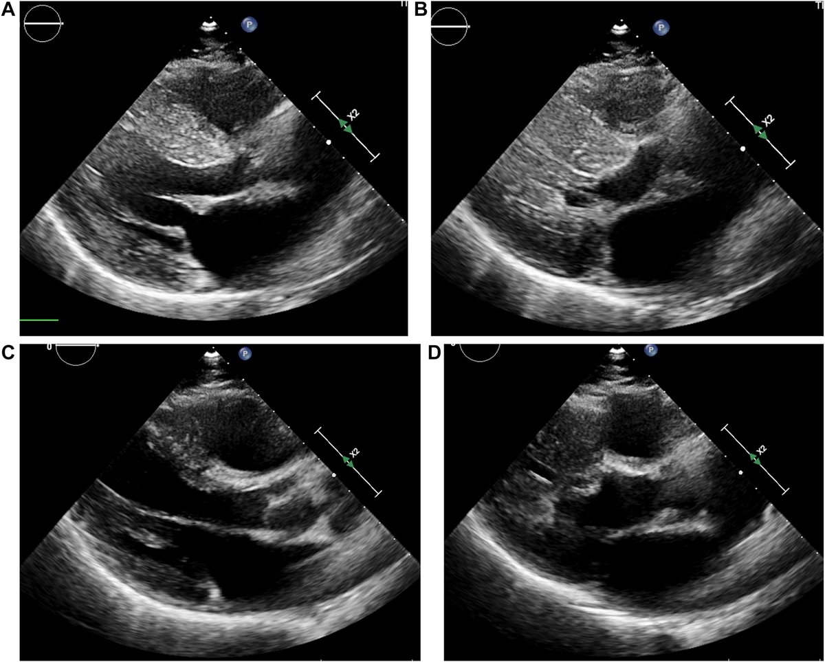 🫀 Alcohol septal ablation was first performed 30 years ago, and has since become an important part of the management of patients with #HypertrophicCardiomyopathy. Read the full #review by @josef_veselka in #CJC 👉 onlinecjc.ca/article/S0828-… #HCM