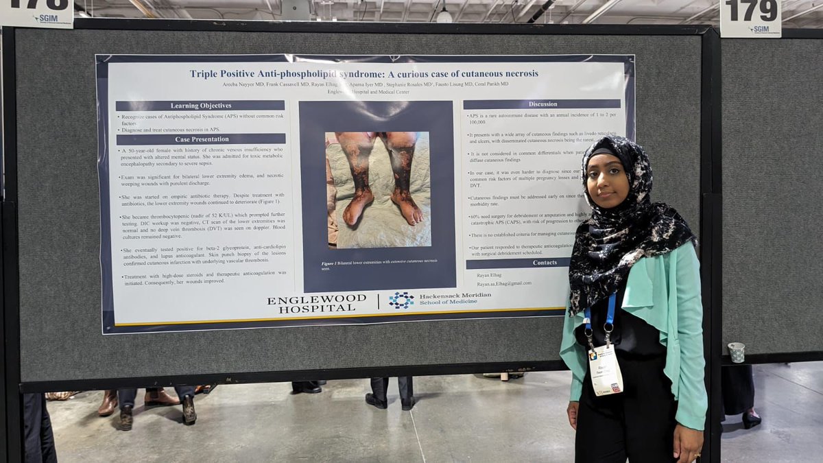 Our paper on 'Triple positive anti phospholipid syndrome: A curious case of cutaneous necrosis' being presented by Rayan Elhag, MD @SocietyGIM. So proud. 🙌🏾🙌🏾 #sgim24 #internalmedicine #IMPROUD @englewood_im