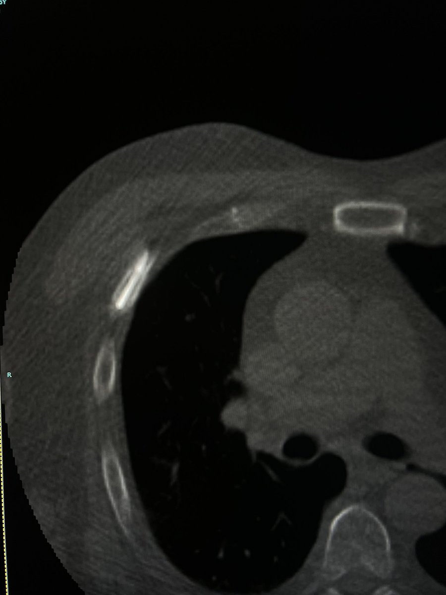 PSMA positive rib lesion. I think rib lesions are the hardest biopsies of all, what’s the rest of #VIRad think?