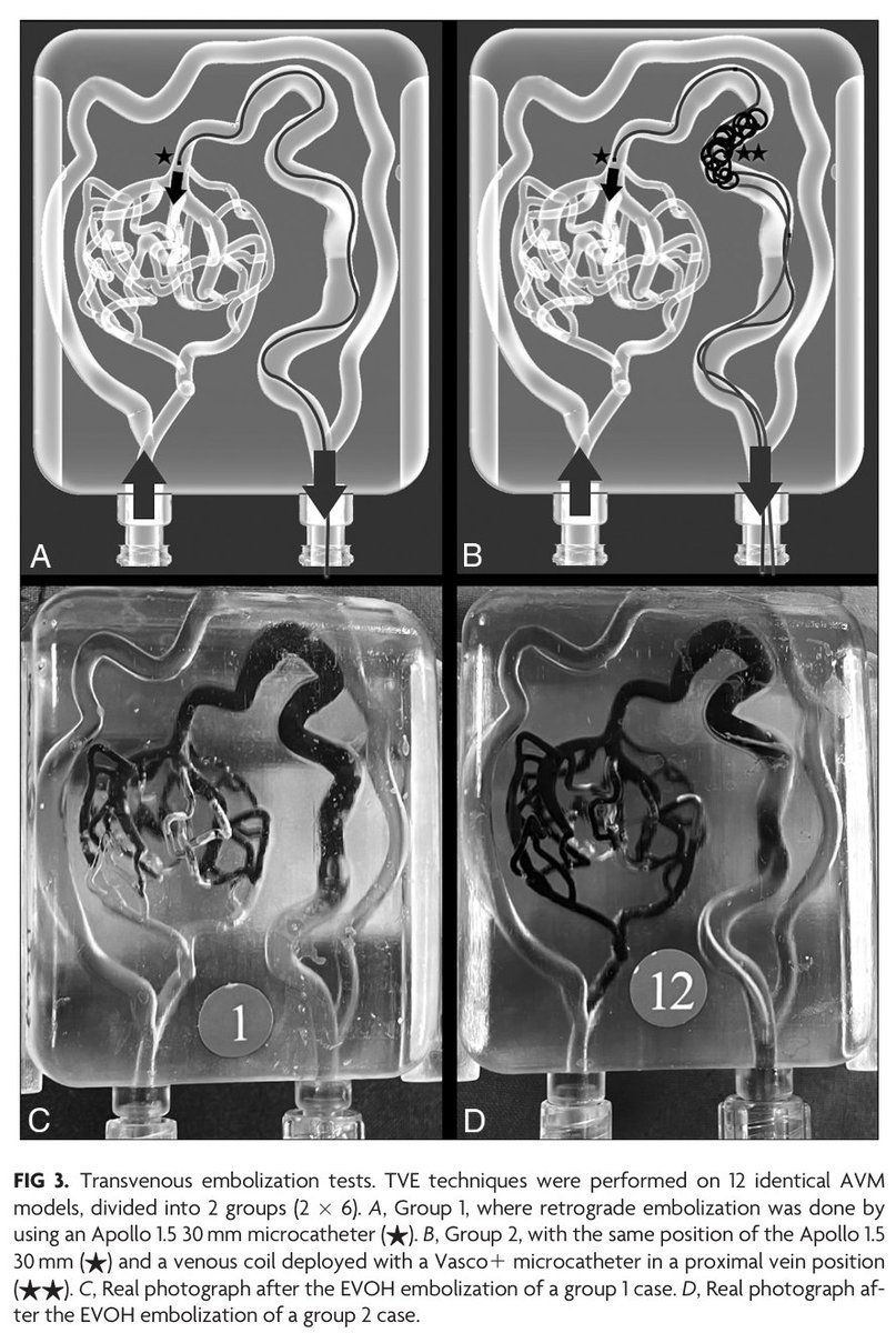 'Brain Arteriovenous Malformation In Vitro Model for Transvenous Embolization Using 3D Printing and Real Patient Data' doi.org/10.3174/ajnr.A… @neurofox #AVM