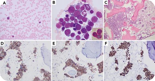 AEL transformed from post-ET myelofibrosis with a sinusoidal pattern, JAK2 mutation, and biallelic TP53 inactivation ow.ly/Nj9U50RIL7r #bloodwork #myeloidneoplasia